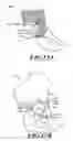 Fig. 14 - DEVICES AND METHODS FOR HIP REPLACEMENT