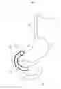 Fig. 02 - Gastrointestinal device with associated commensal microbes