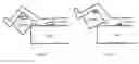 Fig. 47 - Cuboid human spinal traction device