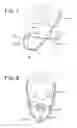 Fig. 02 - Sleep apnea prevention