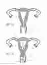 Fig. 03 - INTRAUTERINE DEVICE