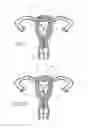 Fig. 04 - INTRAUTERINE DEVICE