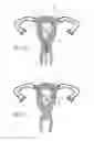 Fig. 05 - INTRAUTERINE DEVICE