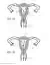 Fig. 07 - INTRAUTERINE DEVICE