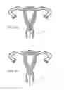 Fig. 09 - INTRAUTERINE DEVICE