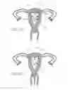 Fig. 26 - INTRAUTERINE DEVICE