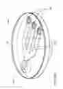 Fig. 18 - Apparatus and method for reducing intraocular pressure