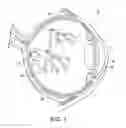 Fig. 02 - Subthreshold micropulse laser prophylactic treatment for chronic progressive retinal diseases