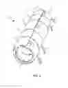 Fig. 04 - External peripheral vascular occlusion for enhanced cardiopulmonary resuscitation