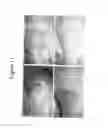 Fig. 12 - Methods of use for 2,5-dihydroxybenzene sulfonic acid compounds for the treatment of cancer