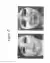 Fig. 18 - Methods of use for 2,5-dihydroxybenzene sulfonic acid compounds for the treatment of cancer