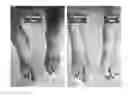 Fig. 01 - TOPICAL PERIPHERAL NEURO-AFFECTIVE (TPNA) THERAPY FOR NEUROPATHIC CONDITIONS