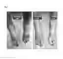 Fig. 03 - TOPICAL PERIPHERAL NEURO-AFFECTIVE (TPNA) THERAPY FOR NEUROPATHIC CONDITIONS