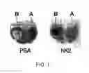 Fig. 02 - DIAGNOSIS OF PROSTATE CANCER