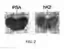 Fig. 03 - DIAGNOSIS OF PROSTATE CANCER