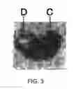 Fig. 04 - DIAGNOSIS OF PROSTATE CANCER