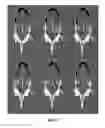 Fig. 10 - Radioactive bone cement