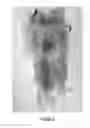 Fig. 27 - Radioactive bone cement