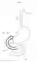 Fig. 02 - Gastrointestinal device with associated microbe-promoting agents