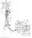 Fig. 01 - Intra-aortic balloon counterpulsation with concurrent hypothermia