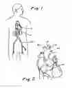 Fig. 02 - Intra-aortic balloon counterpulsation with concurrent hypothermia
