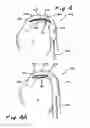 Fig. 04 - Intra-aortic balloon counterpulsation with concurrent hypothermia