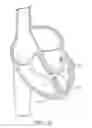 Fig. 30 - Steerable sheath including elastomeric member