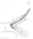 Fig. 11 - Method and apparatus for guiding a catheter