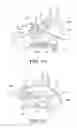 Fig. 09 - Balloon catheters and methods for treating paranasal sinuses