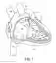 Fig. 02 - Interventional medical systems, devices, and components thereof