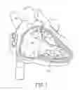 Fig. 02 - Interventional medical systems, devices, and methods of use