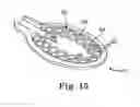 Fig. 16 - Paddle leads configured for suture fixation