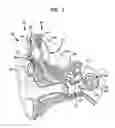 Fig. 02 - Intra-cochlear stimulating assembly insertion