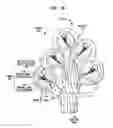 Fig. 03 - Intra-cochlear stimulating assembly insertion
