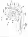 Fig. 04 - Intra-cochlear stimulating assembly insertion