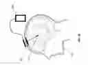 Fig. 03 - Leadless neurostimulator