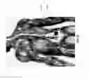 Fig. 56 - Leadless neurostimulator