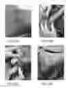 Fig. 09 - Subcutaneous wound debridement