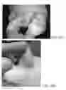Fig. 10 - Subcutaneous wound debridement