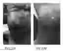 Fig. 11 - Subcutaneous wound debridement