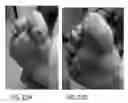 Fig. 12 - Subcutaneous wound debridement