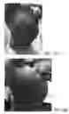 Fig. 13 - Subcutaneous wound debridement