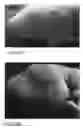 Fig. 14 - Subcutaneous wound debridement