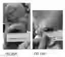Fig. 15 - Subcutaneous wound debridement