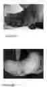 Fig. 16 - Subcutaneous wound debridement