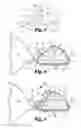 Fig. 03 - Balloon tying aid