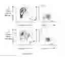 Fig. 17 - Markers of acute myeloid leukemia stem cells
