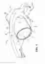 Fig. 05 - Rocker arm assembly and valvetrain assembly incorporating the same