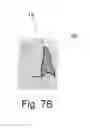 Fig. 11 - System and Method for Customized Anatomical Implant Prosthetic Pieces