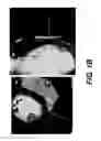 Fig. 03 - Systems and methods for automatically determining myocardial bridging and patient impact